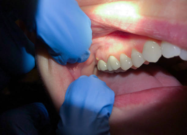Best Teeth Whitening  in Evansville, WY